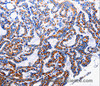 Immunohistochemistry of paraffin-embedded Human thyroid cancer tissue using NFκB-p105 Polyclonal Antibody at dilution 1:40