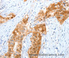 Immunohistochemistry of paraffin-embedded Human cervical cancer using ANXA8 Polyclonal Antibody at dilution of 1:35