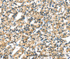 Immunohistochemistry of paraffin-embedded Human prostate cancer tissue using CK-17 Polyclonal Antibody at dilution 1:40