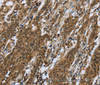 Immunohistochemistry of paraffin-embedded Human gastric cancer using RAP1B Polyclonal Antibody at dilution of 1:50