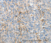 Immunohistochemistry of paraffin-embedded Human esophagus cancer using APOH Polyclonal Antibody at dilution of 1:30