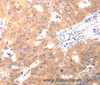 Immunohistochemistry of paraffin-embedded Human ovarian cancer using CAPNS1 Polyclonal Antibody at dilution of 1:60