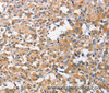 Immunohistochemistry of paraffin-embedded Human thyroid cancer tissue using CCL4 Polyclonal Antibody at dilution 1:40