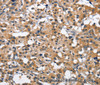 Immunohistochemistry of paraffin-embedded Human thyroid cancer tissue using CEACAM3 Polyclonal Antibody at dilution 1:70