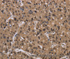 Immunohistochemistry of paraffin-embedded Human liver cancer using CSNK2A1 Polyclonal Antibody at dilution of 1:30