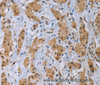 Immunohistochemistry of paraffin-embedded Human breast cancer tissue using CLEC1A Polyclonal Antibody at dilution 1:40