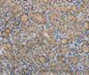 Immunohistochemistry of paraffin-embedded Human thyroid cancer tissue using CLEC1A Polyclonal Antibody at dilution 1:40