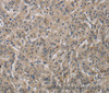 Immunohistochemistry of paraffin-embedded Human gastric cancer tissue using DCN Polyclonal Antibody at dilution 1:30
