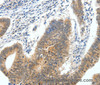 Immunohistochemistry of paraffin-embedded Human colon cancer tissue using ECE2 Polyclonal Antibody at dilution 1:40