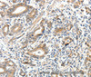 Immunohistochemistry of paraffin-embedded Human gastric cancer tissue using ECE2 Polyclonal Antibody at dilution 1:40