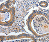 Immunohistochemistry of paraffin-embedded Human colon cancer tissue using EFNB2 Polyclonal Antibody at dilution 1:80