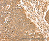 Immunohistochemistry of paraffin-embedded Human lung cancer using ERK 5 Polyclonal Antibody at dilution of 1:35