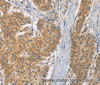 Immunohistochemistry of paraffin-embedded Human gasrtic cancer tissue using FASTK Polyclonal Antibody at dilution 1:30