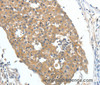 Immunohistochemistry of paraffin-embedded Human breast cancer tissue using FSHR Polyclonal Antibody at dilution 1:70