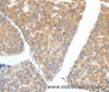 Immunohistochemistry of paraffin-embedded Human liver cancer tissue using FSHR Polyclonal Antibody at dilution 1:70