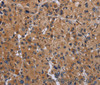 Immunohistochemistry of paraffin-embedded Human liver cancer using GNAS Polyclonal Antibody at dilution of 1:30