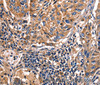Immunohistochemistry of paraffin-embedded Human lung cancer tissue using Galectin 8 Polyclonal Antibody at dilution 1:50