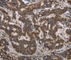 Immunohistochemistry of paraffin-embedded Human liver cancer tissue using LGALS2 Polyclonal Antibody at dilution 1:30