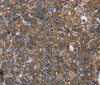 Immunohistochemistry of paraffin-embedded Human ovarian cancer tissue using LGALS2 Polyclonal Antibody at dilution 1:30