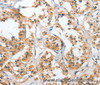 Immunohistochemistry of paraffin-embedded Human thyroid cancer tissue using UGCG Polyclonal Antibody at dilution 1:50