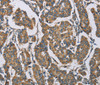 Immunohistochemistry of paraffin-embedded Human breast cancer tissue using HDAC6 Polyclonal Antibody at dilution 1:50