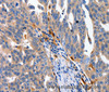 Immunohistochemistry of paraffin-embedded Human ovarian cancer using IL18 Polyclonal Antibody at dilution of 1:100