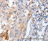 Immunohistochemistry of paraffin-embedded Human cervical cancer using IL18 Polyclonal Antibody at dilution of 1:100