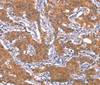 Immunohistochemistry of paraffin-embedded Human gasrtic cancer tissue using IRS1 Polyclonal Antibody at dilution 1:30