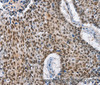 Immunohistochemistry of paraffin-embedded Human lung cancer tissue using GNRH1 Polyclonal Antibody at dilution 1:65