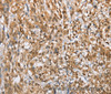 Immunohistochemistry of paraffin-embedded Human esophagus cancer tissue using MMP12 Polyclonal Antibody at dilution of 1:60
