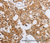Immunohistochemistry of paraffin-embedded Human lung cancer using MUC20 Polyclonal Antibody at dilution of 1:40