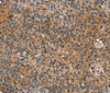 Immunohistochemistry of paraffin-embedded Human esophagus cancer tissue using TAC1 Polyclonal Antibody at dilution 1:25