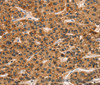 Immunohistochemistry of paraffin-embedded Human liver cancer tissue using CD159a/c Polyclonal Antibody at dilution 1:30