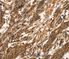 Immunohistochemistry of paraffin-embedded Human gastric cancer tissue using CD159a/c Polyclonal Antibody at dilution 1:30