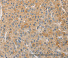 Immunohistochemistry of paraffin-embedded Human liver cancer using NFE2L1 Polyclonal Antibody at dilution of 1:30