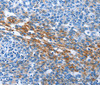 Immunohistochemistry of paraffin-embedded Human ovarian cancer tissue using PAK6 Polyclonal Antibody at dilution 1:40