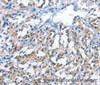 Immunohistochemistry of paraffin-embedded Human thyroid cancer tissue using PAK6 Polyclonal Antibody at dilution 1:40