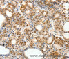 Immunohistochemistry of paraffin-embedded Human thyroid cancer using PDCD6 Polyclonal Antibody at dilution of 1:30