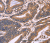 Immunohistochemistry of paraffin-embedded Human colon cancer tissue using S100A13 Polyclonal Antibody at dilution 1:40