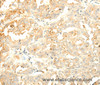 Immunohistochemistry of paraffin-embedded Human gastric cancer tissue using SOCS6 Polyclonal Antibody at dilution 1:50