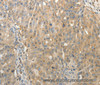 Immunohistochemistry of paraffin-embedded Human ovarian cancer using SULT1E1 Polyclonal Antibody at dilution of 1:30