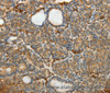 Immunohistochemistry of paraffin-embedded Human thyroid cancer using SULT1E1 Polyclonal Antibody at dilution of 1:30