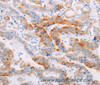 Immunohistochemistry of paraffin-embedded Human thyroid cancer using MAP4K3 Polyclonal Antibody at dilution of 1:30