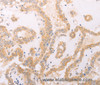 Immunohistochemistry of paraffin-embedded Human thyroid cancer using F7 Polyclonal Antibody at dilution of 1:40