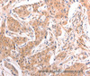 Immunohistochemistry of paraffin-embedded Human lung cancer tissue using TNF beta Polyclonal Antibody at dilution 1:50
