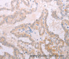 Immunohistochemistry of paraffin-embedded Human thyroid cancer tissue using TPO Polyclonal Antibody at dilution 1:50