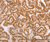 Immunohistochemistry of paraffin-embedded Human thyroid cancer tissue using HEXIM1 Polyclonal Antibody at dilution 1:65