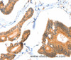 Immunohistochemistry of paraffin-embedded Human colon cancer tissue using ACOX3 Polyclonal Antibody at dilution 1:35