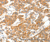 Immunohistochemistry of paraffin-embedded Human breast cancer tissue using ADAMTS18 Polyclonal Antibody at dilution 1:30