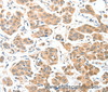 Immunohistochemistry of paraffin-embedded Human breast cancer tissue using ADCK1 Polyclonal Antibody at dilution 1:40